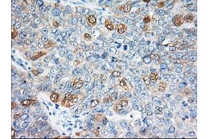Immunohistochemical staining of paraffin-embedded Adenocarcinoma of Human colon tissue using anti-EIF2S1 mouse monoclonal antibody. (EIF2S1 抗体)