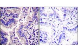 Immunohistochemistry analysis of paraffin-embedded human lung carcinoma tissue, using Caspase 9 (Cleaved-Asp315) Antibody. (Caspase 9 抗体  (Cleaved-Asp315))