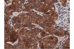 Immunohistochemical staining of paraffin-embedded Adenocarcinoma of Human breast tissue using anti-DNAJA2 mouse monoclonal antibody. (DNAJA2 抗体)