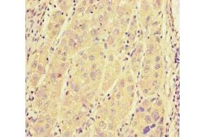 Immunohistochemistry of paraffin-embedded human liver cancer using ABIN7168958 at dilution of 1:100 (SRRM2 抗体  (AA 248-462))