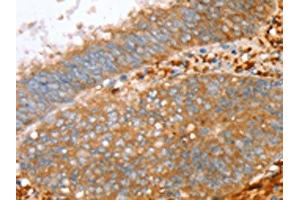 The image on the left is immunohistochemistry of paraffin-embedded Human cervical cancer tissue using ABIN7130778(PTPN7 Antibody) at dilution 1/30, on the right is treated with fusion protein. (PTPN7 抗体)