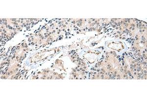 Immunohistochemistry of paraffin-embedded Human prost at e cancer tissue using S100A16 Polyclonal Antibody at dilution of 1:25(x200) (S100A16 抗体)