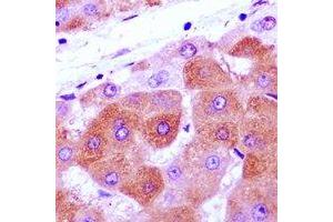 Immunohistochemical analysis of NRAGE staining in human liver cancer formalin fixed paraffin embedded tissue section. (MAGED1 抗体)