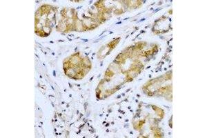 Immunohistochemical analysis of SMYD4 staining in human stomach cancer formalin fixed paraffin embedded tissue section. (SMYD4 抗体)