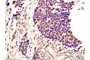 Formalin-fixed and paraffin embedded human lung cancer labeled with Anti-SNAI2/SLUG Polyclonal Antibody, Unconjugated (ABIN685747) followed by conjugation to the secondary antibody and DAB staining (SLUG 抗体  (AA 5-120))
