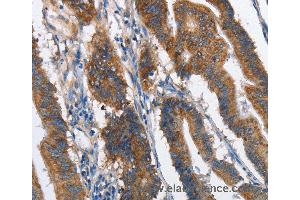 Immunohistochemistry of Human lung cancer using MAD2L1BP Polyclonal Antibody at dilution of 1:60 (MAD2L1BP 抗体)