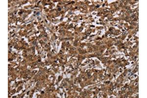 The image on the left is immunohistochemistry of paraffin-embedded Human liver cancer tissue using ABIN7192743(TBX5 Antibody) at dilution 1/35, on the right is treated with synthetic peptide. (T-Box 5 抗体)