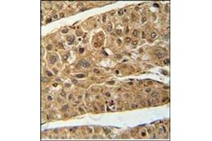 Immunohistochemistry analysis in Formalin Fixed and Paraffin Embedded Human hepatocarcinoma using RT4I1 Antibody (C-term) followed by peroxidase conjugation of the secondary antibody and DAB staining. (RTN4IP1 抗体  (C-Term))