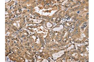 The image on the left is immunohistochemistry of paraffin-embedded Human thyroid cancer tissue using ABIN7191987(PPP2R3A Antibody) at dilution 1/30, on the right is treated with synthetic peptide.