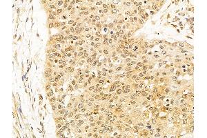 ABIN6263806 and ABIN6273061 at 1/100 staining Human esophageal cancer by IHC-P. (OIP5 抗体  (C-Term))