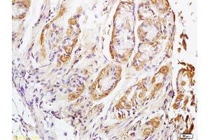 Formalin-fixed and paraffin embedded human lung carcinoma labeled with Rabbit Anti NALP4 Polyclonal Antibody, Unconjugated (ABIN872353) at 1:200 followed by conjugation to the secondary antibody and DAB staining (NLRP4 抗体  (AA 351-450))