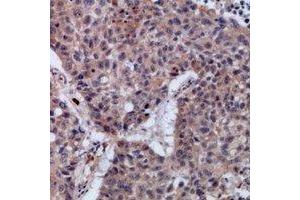 Immunohistochemical analysis of SETMAR staining in human lung cancer formalin fixed paraffin embedded tissue section. (SETMAR 抗体)