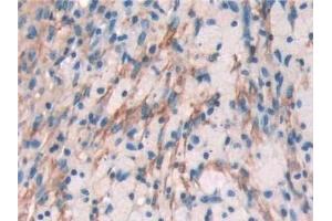 Detection of FLNa in Human Lung cancer Tissue using Polyclonal Antibody to Filamin A Alpha (FLNa)