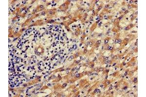 Immunohistochemistry of paraffin-embedded human liver cancer using ABIN7142472 at dilution of 1:100 (ALDH9A1 抗体  (AA 12-144))