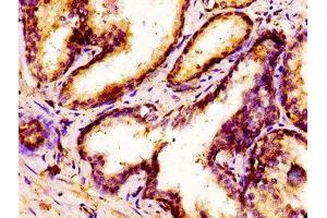 IHC image of ABIN7155804 diluted at 1:300 and staining in paraffin-embedded human prostate cancer performed on a Leica BondTM system. (MSX1 抗体  (AA 19-179))