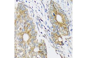 Immunohistochemistry of paraffin-embedded Human colon carcinoma using CLCC1 Rabbit pAb (ABIN7266333) at dilution of 1:100 (40x lens). (CLCC1 抗体  (AA 302-501))