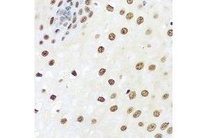 Immunohistochemical analysis of hnRNP A0 staining in human esophageal cancer formalin fixed paraffin embedded tissue section. (HNRNPA0 抗体)