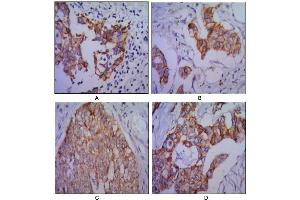 Immunohistochemical analysis of paraffin-embedded human lung cancer (A), colon cancer (B), ovarian cancer (C) and mammary cancer(D), using CDH2 antibody with DAB staining. (N-Cadherin 抗体)