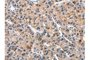 The image on the left is immunohistochemistry of paraffin-embedded Human liver cancer tissue using ABIN7190518(DUSP2 Antibody) at dilution 1/30, on the right is treated with synthetic peptide. (DUSP2 抗体)