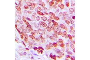 Immunohistochemical analysis of FOXD3 staining in human prostate cancer formalin fixed paraffin embedded tissue section. (FOXD3 抗体  (Center))