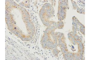 IHC-P Image Immunohistochemical analysis of paraffin-embedded human colon carcinoma, using PDYN, antibody at 1:250 dilution. (PDYN 抗体)
