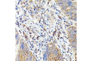 Immunohistochemistry of paraffin-embedded human colon carcinoma using T Rabbit pAb (ABIN3022236, ABIN3022237, ABIN3022238, ABIN1513586 and ABIN6218687) at dilution of 1:100 (40x lens). (TAP2 抗体  (AA 430-680))