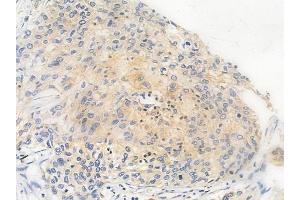 ABIN6263862 and ABIN6272701 at 1/100 staining human cervical carcinoma by IHC-P.