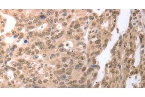 Immunohistochemistry of paraffin-embedded Human ovarian cancer tissue using RAD52 Polyclonal Antibody at dilution 1:50 (RAD52 抗体)
