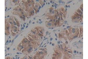 DAB staining on IHC-P; Samples: Human Stomach cancer Tissue (HSD17B12 抗体  (AA 1-312))