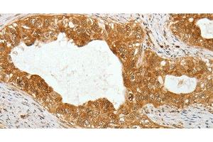 Immunohistochemistry of paraffin-embedded Human cervical cancer using TEKT1 Polyclonal Antibody at dilution of 1:30 (TEKT1 抗体)
