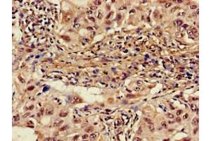 Immunohistochemistry of paraffin-embedded human lung cancer using ABIN7142600 at dilution of 1:100 (ALAS1 抗体  (AA 57-285))