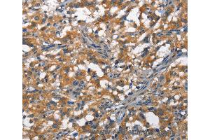 Immunohistochemistry of Human thyroid cancer using DDR2 Polyclonal Antibody at dilution of 1:40 (DDR2 抗体)
