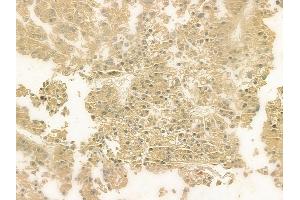 ABIN6263552 and ABIN6276984 at 1/100 staining human hepatocellular carcinoma by IHC-P. (Norrie Disease (Pseudoglioma) 抗体  (Internal Region))