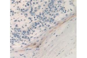 Used in DAB staining on fromalin fixed paraffin- embedded skin cancer tissue (Urocortin 2 抗体  (AA 20-112))