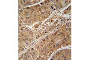 Immunohistochemical staining of formalin-fixed and paraffin-embedded human hepatocarcinoma reacted with RPS6KB2 monoclonal antibody  at 1:50-1:100 dilution. (RPS6KB2 抗体)