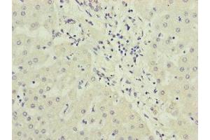 Immunohistochemistry of paraffin-embedded human liver cancer using ABIN7169283 at dilution of 1:100 (PPP2R3B 抗体  (Regulatory Subunit B))