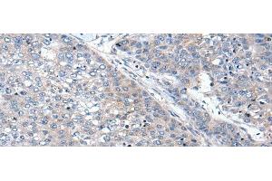 Immunohistochemistry of paraffin-embedded Human liver cancer tissue using WIF1 Polyclonal Antibody at dilution of 1:100(x200) (WIF1 抗体)