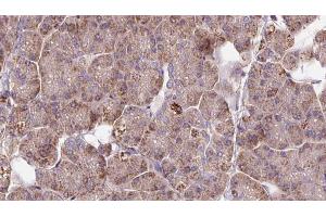 ABIN6273286 at 1/100 staining Human pancreas cancer tissue by IHC-P. (PAFAH2 抗体  (Internal Region))
