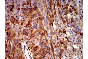 Immunohistochemical analysis of paraffin-embedded ovarian cancer tissues using C3C mouse mAb with DAB staining. (Complement C3c 抗体  (AA 1521-1649))