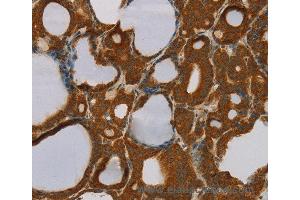 Immunohistochemistry of Human liver cancer using PARP3 Polyclonal Antibody at dilution of 1:40 (PARP3 抗体)