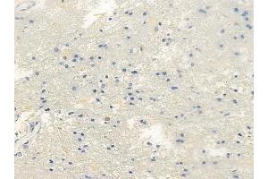 ABIN6261314 and ABIN6266687 at 1/100 staining human glioblastoma by IHC-P. (DLGAP1 抗体  (Internal Region))