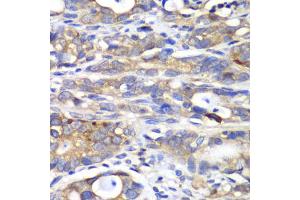 Immunohistochemistry of paraffin-embedded human gastric cancer using HAPLN1 antibody. (HAPLN1 抗体)