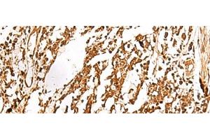 Immunohistochemistry of paraffin-embedded Human lung cancer tissue using TERF1 Polyclonal Antibody at dilution of 1:30(x200) (TRF1 抗体)