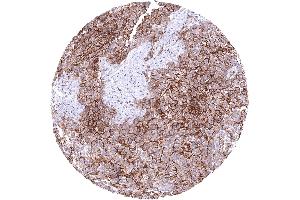 Lung Malignant mesothelioma with strong CD141 immunostaining of tumor cells CD141 immunohistochemistry. (Recombinant Thrombomodulin 抗体  (AA 69-194))