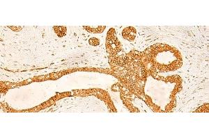 Immunohistochemistry of paraffin-embedded Human ovarian cancer tissue using KRT76 Polyclonal Antibody at dilution of 1:50(x200) (Cytokeratin 2 抗体)