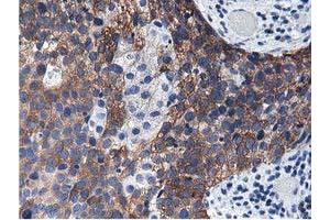 Immunohistochemical staining of paraffin-embedded Carcinoma of Human kidney tissue using anti-ALDH1L1 mouse monoclonal antibody. (ALDH1L1 抗体)