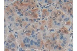 Detection of FASL in Human Liver cancer Tissue using Polyclonal Antibody to Factor Related Apoptosis Ligand (FASL) (FASL 抗体)