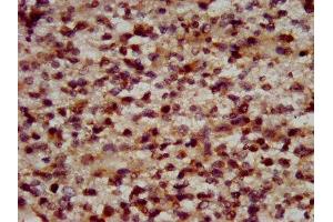 IHC image of ABIN7150380 diluted at 1:600 and staining in paraffin-embedded human glioma performed on a Leica BondTM system. (RFX2 抗体  (AA 1-130))