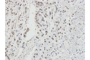 IHC-P Image Immunohistochemical analysis of paraffin-embedded A549 xenograft, using RPA32/RPA2, antibody at 1:100 dilution. (RPA2 抗体)