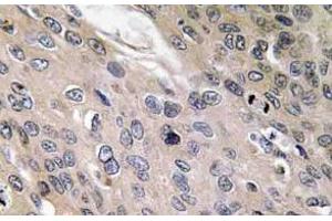 Immunohistochemistry (IHC) analyzes of BMP-6 antibody in paraffin-embedded human lung carcinoma tissue. (BMP6 抗体)